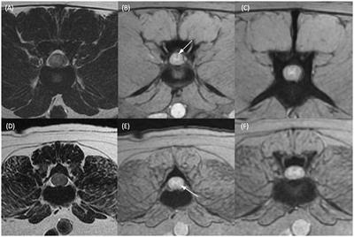 Significance of intramedullary T2* signal voids in the magnetic resonance imaging of paraplegic deep pain-negative dogs following intervertebral disc extrusion at short-term follow-up
